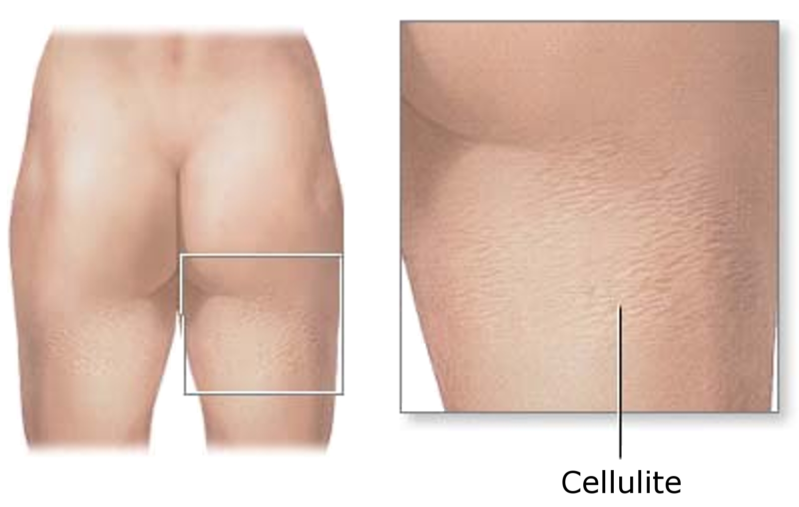 Cellulite Can Be Worked With If You Have Advice stephietca479